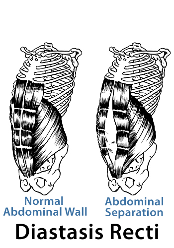 How to check yourself for Diastasis Recti