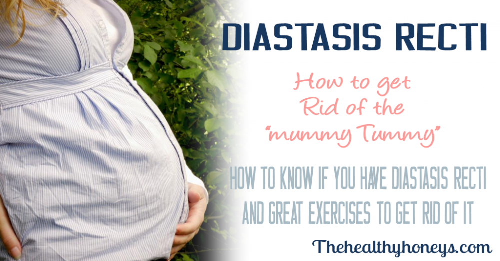 How to Know if You Have Diastasis Recti and What to Do About It - The  Healthy Honey's