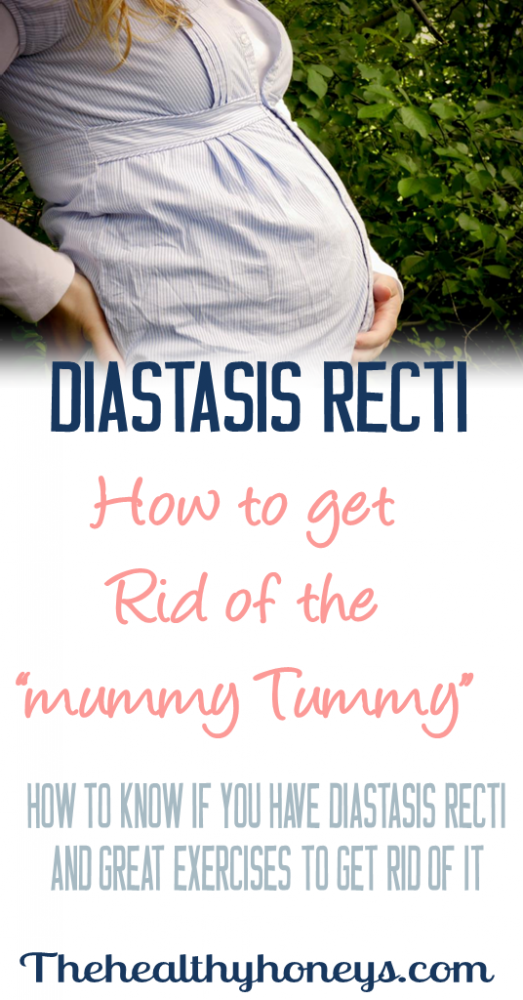 diastasis recti remedy